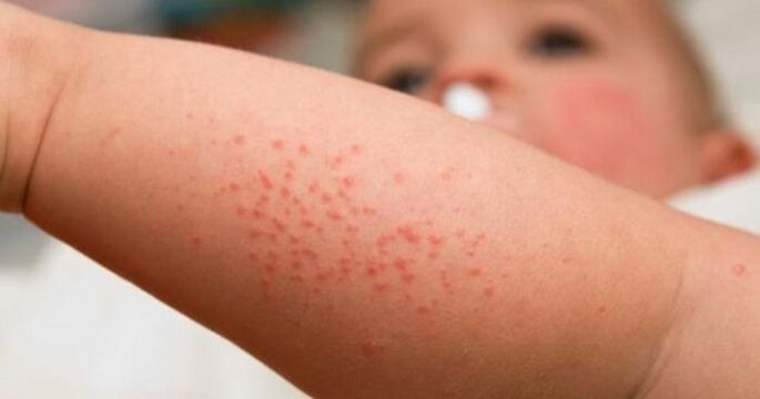 Eruzione cutanea come sintomo di un'infezione parassitaria
